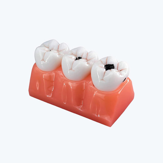 LABZIO Staged Model of Decaying Tooth, Removable and Dissectible Teeth, 7 Parts, Enlarged for Better Observation