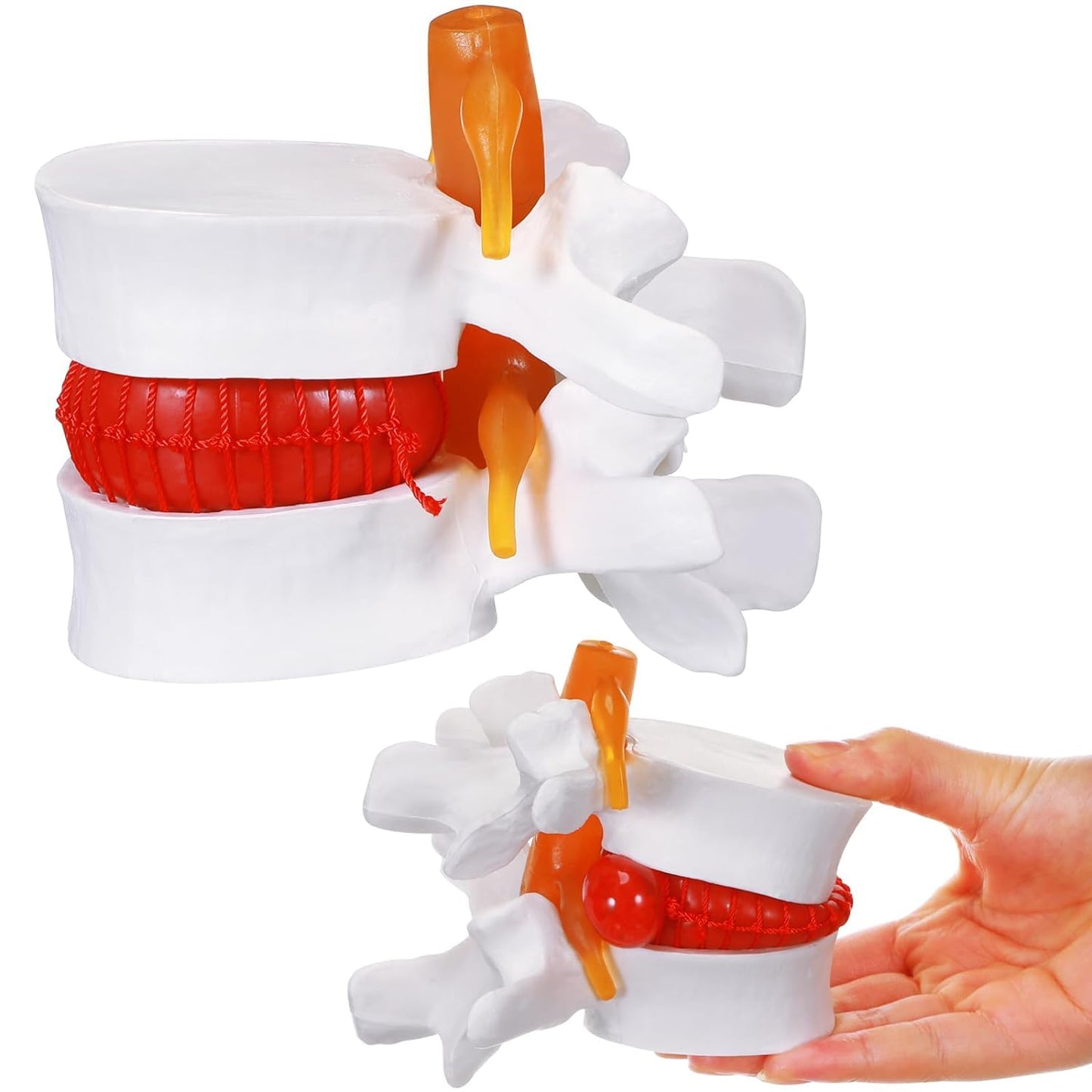 LABZIO Prime Model Of Demonstrational Lumbar Vertebrae With Prolapse, 2 Times Enlarged