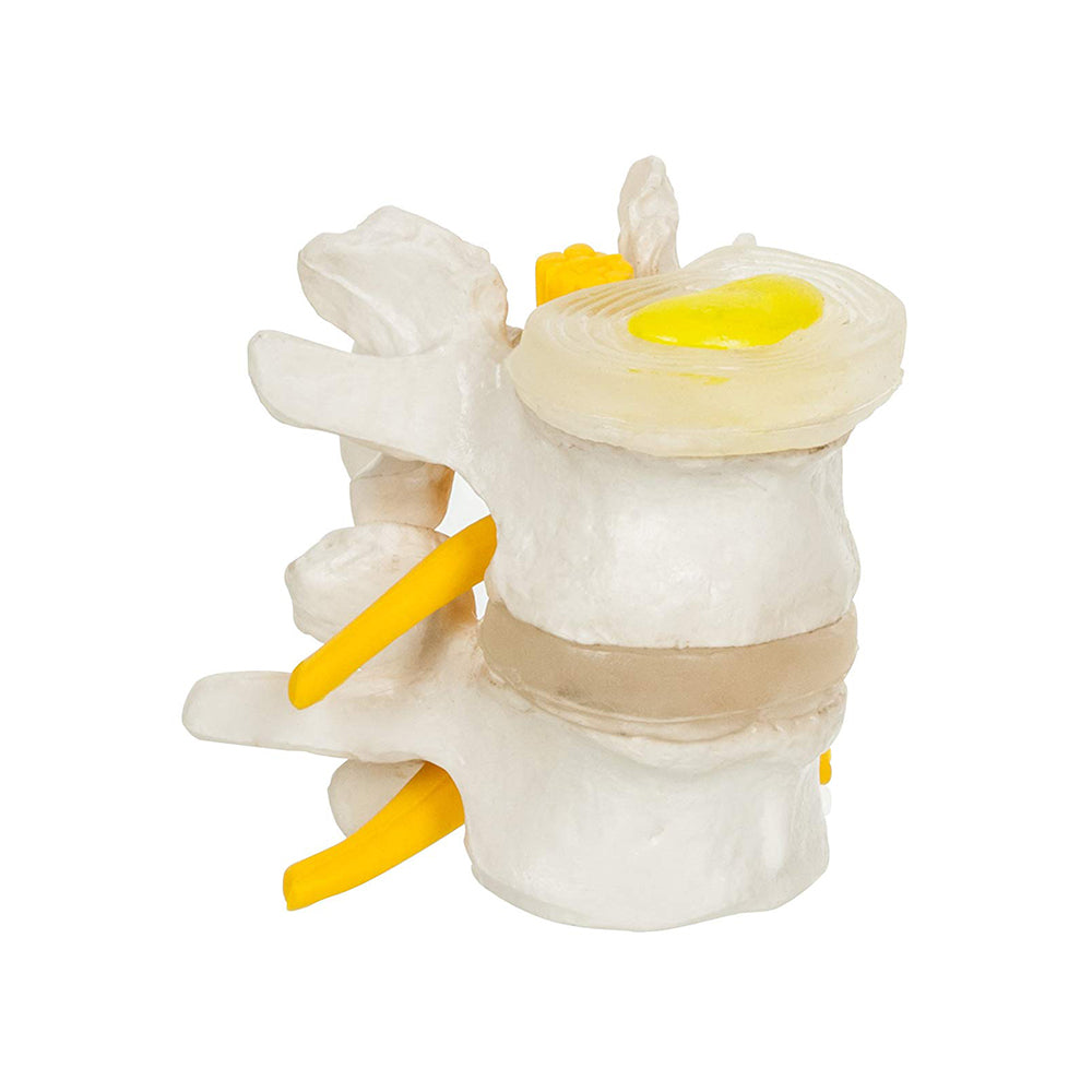 LABZIO, 4 Stage Vertebrae Diseases Model, 4 Parts, Removable, Premium Anatomical Model, Model On Base With Detailed Study Guide, White