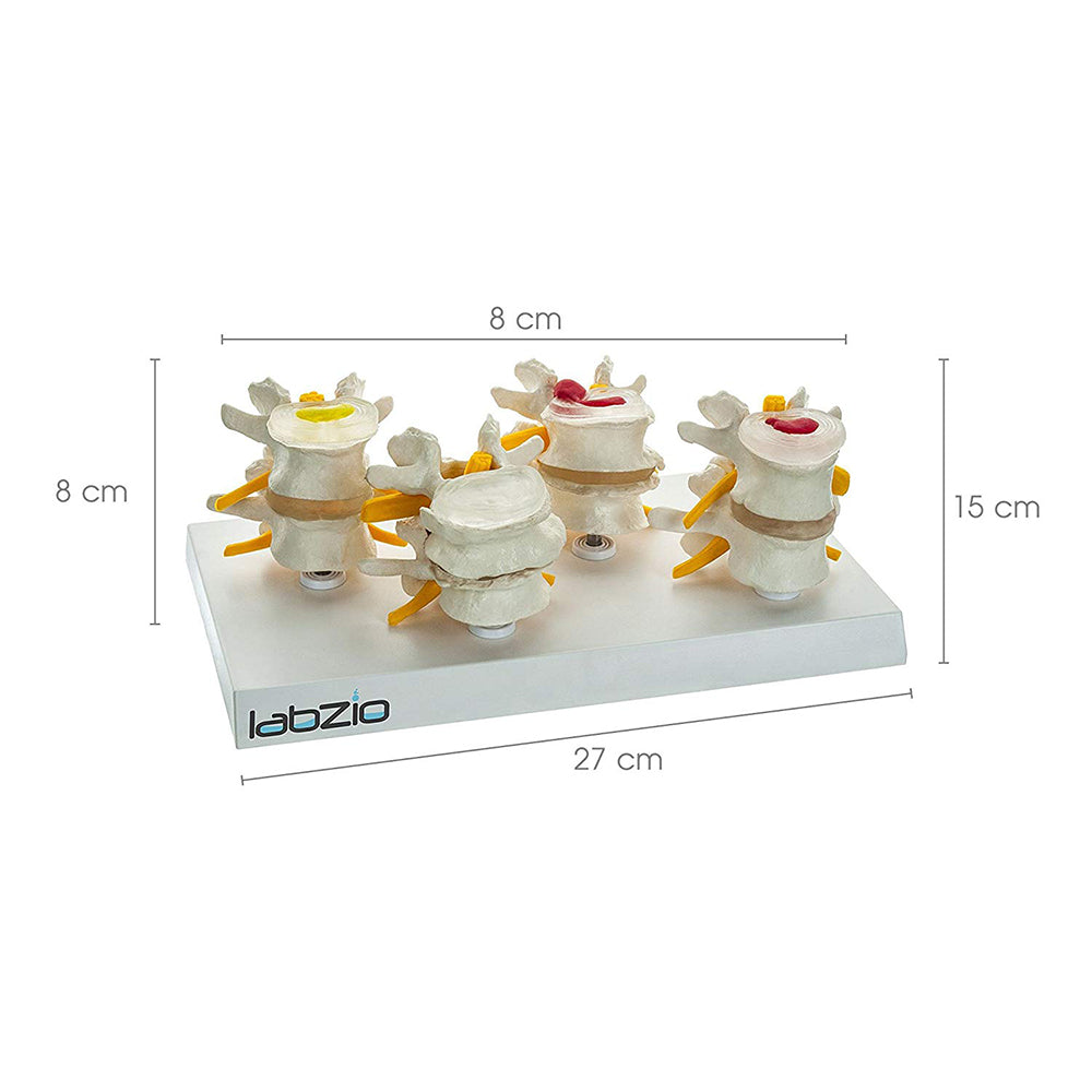 LABZIO, 4 Stage Vertebrae Diseases Model, 4 Parts, Removable, Premium Anatomical Model, Model On Base With Detailed Study Guide, White