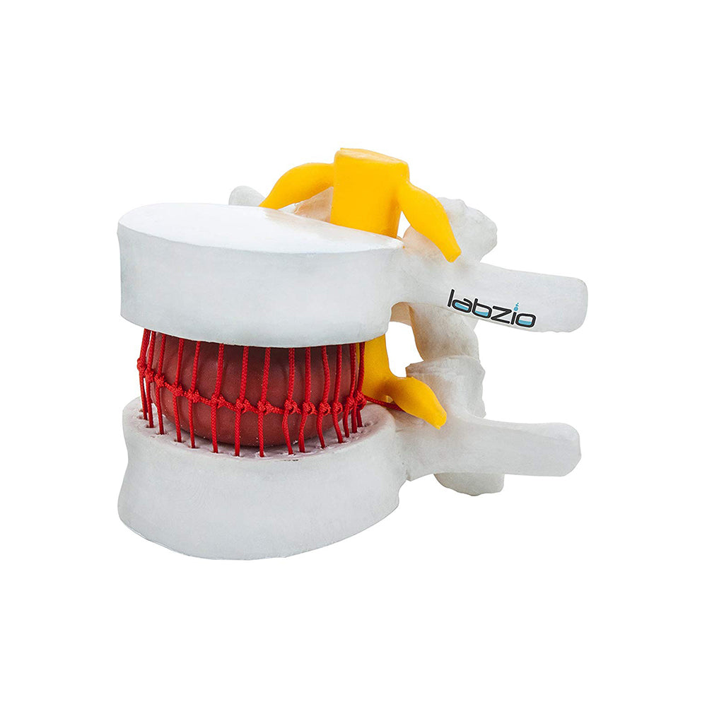 LABZIO Prime Model Of Demonstrational Lumbar Vertebrae With Prolapse, 2 Times Enlarged