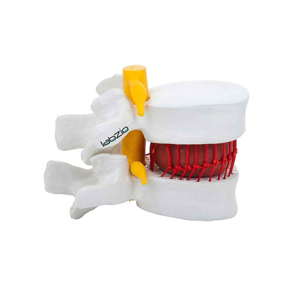 LABZIO Prime Model Of Demonstrational Lumbar Vertebrae With Prolapse, 2 Times Enlarged