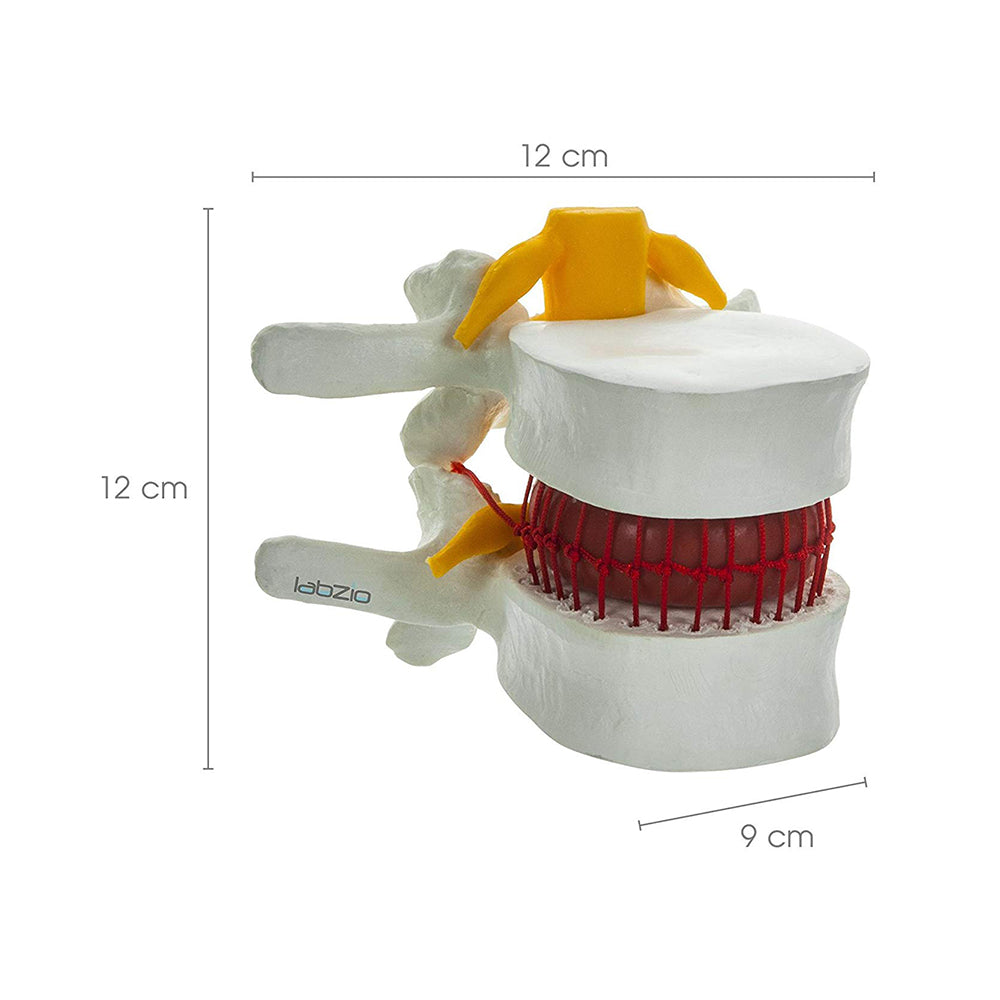 LABZIO Prime Model Of Demonstrational Lumbar Vertebrae With Prolapse, 2 Times Enlarged