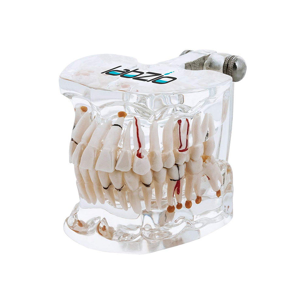 LABZIO Premium Dental Model, Normal Dentition and Occlusion, Affected Side Shows Multiple Pathologies, Made of Yellowish Transparent High Quality Unbreakable Acrylic