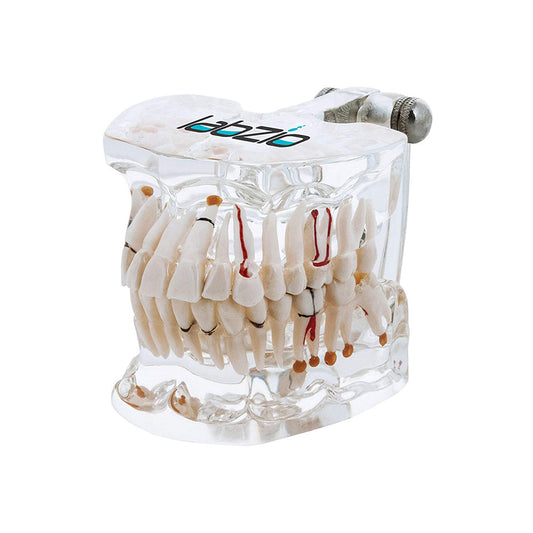 LABZIO Premium Dental Model, Normal Dentition and Occlusion, Affected Side Shows Multiple Pathologies, Made of Yellowish Transparent High Quality Unbreakable Acrylic