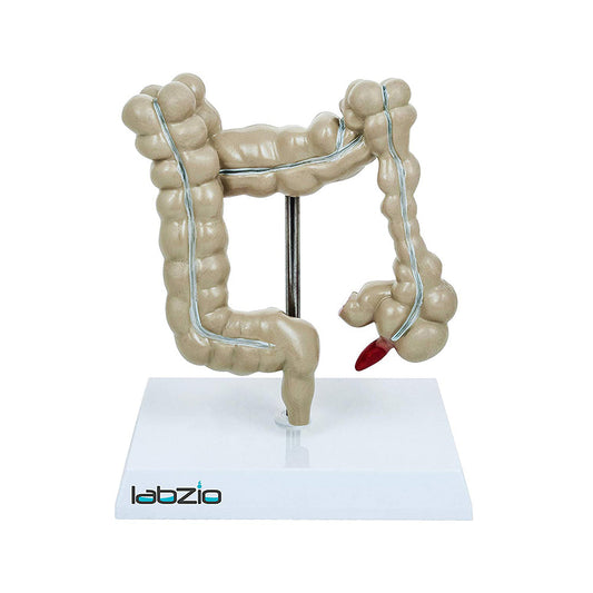Labzio - Medical Anatomical Human Colon Diseased (Large Intestine) Model with Pathologies, Gastro Model, Perfect For Study and Patient Education