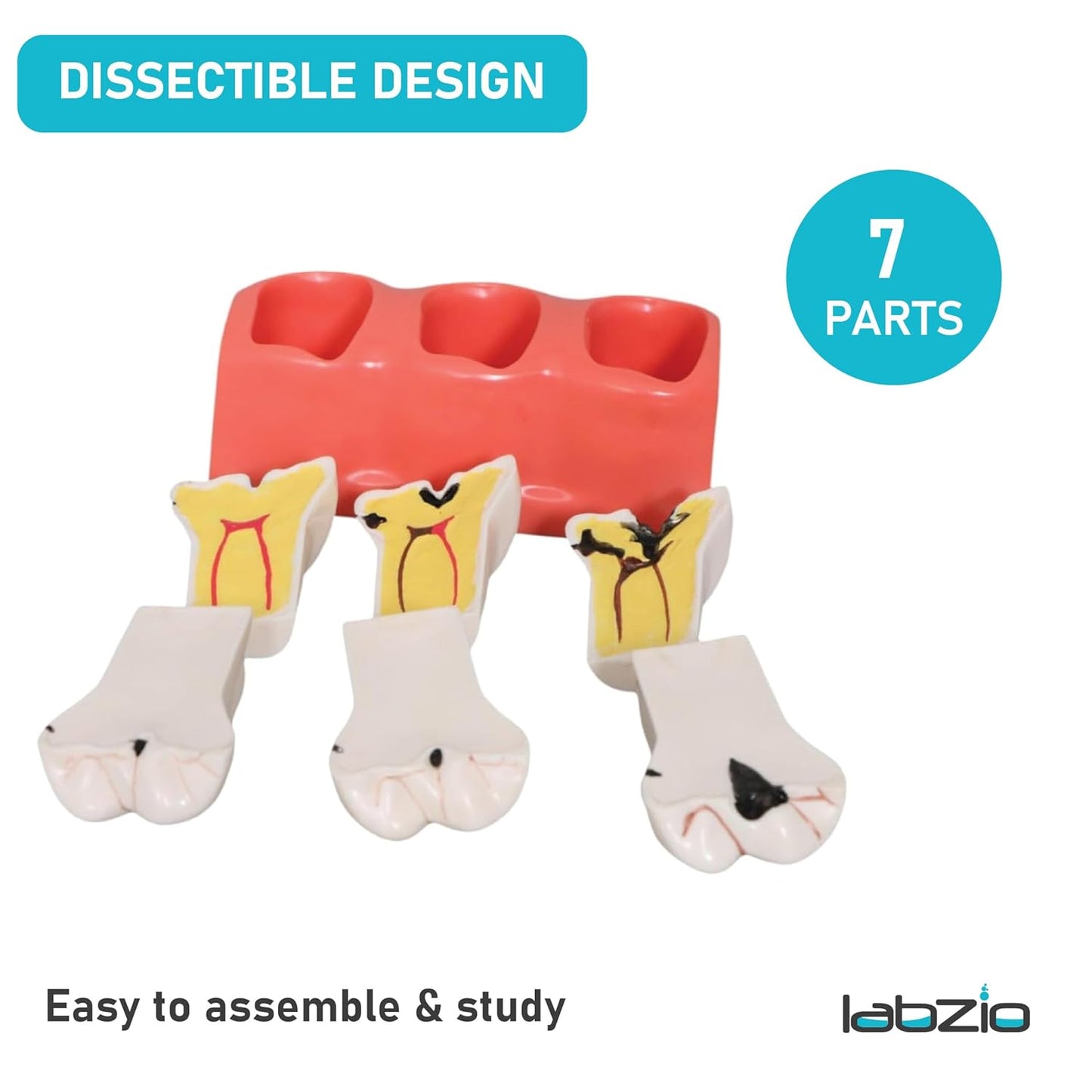LABZIO Staged Model of Decaying Tooth, Removable and Dissectible Teeth, 7 Parts, Enlarged for Better Observation