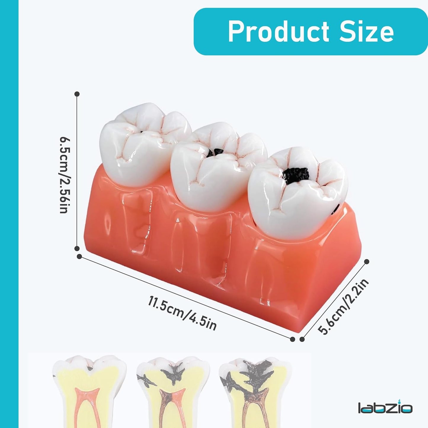 LABZIO Staged Model of Decaying Tooth, Removable and Dissectible Teeth, 7 Parts, Enlarged for Better Observation