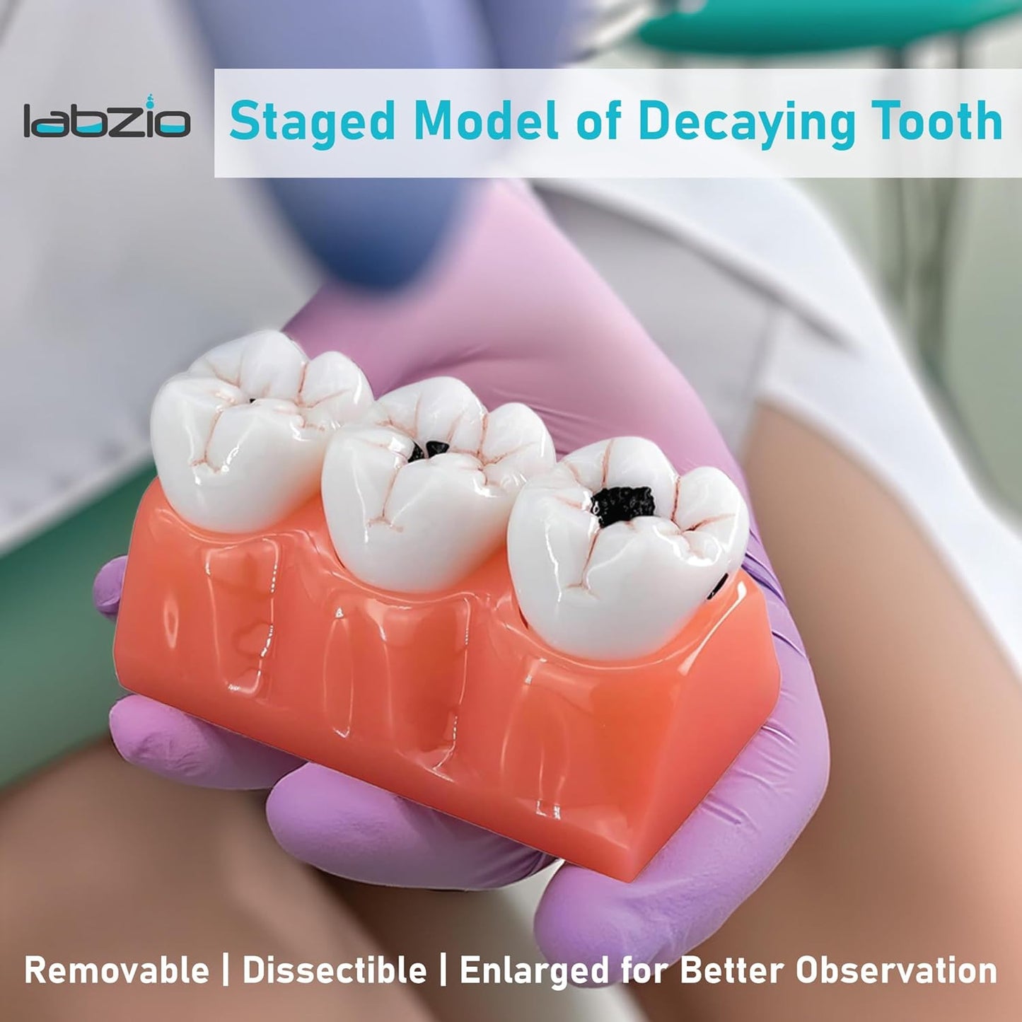 LABZIO Staged Model of Decaying Tooth, Removable and Dissectible Teeth, 7 Parts, Enlarged for Better Observation