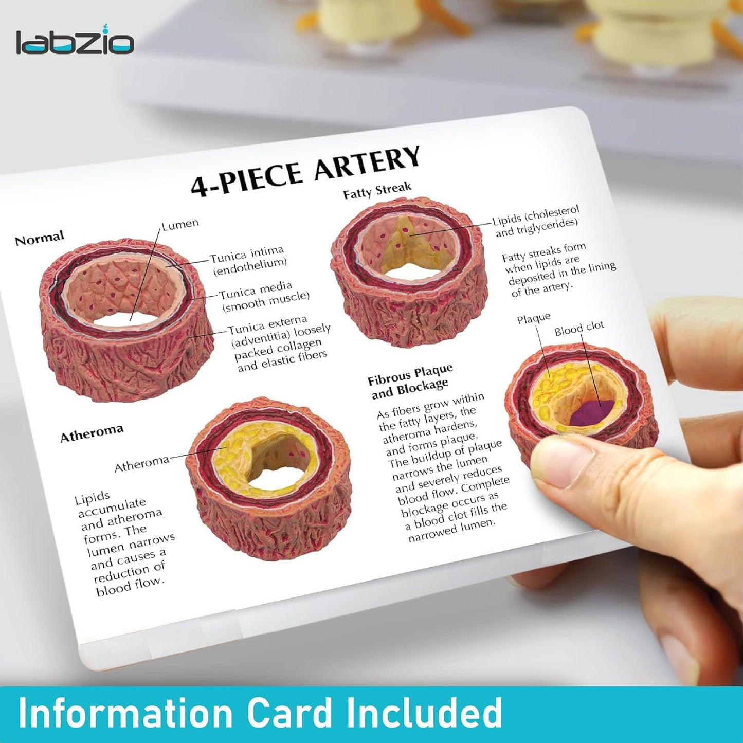 Human Artery Model (Mini) Portraying 4 Stages of Cholesterol Atherosclerosis (Normal, Fatty Streak, Atheroma and Fibrous Plaque and Blockage)