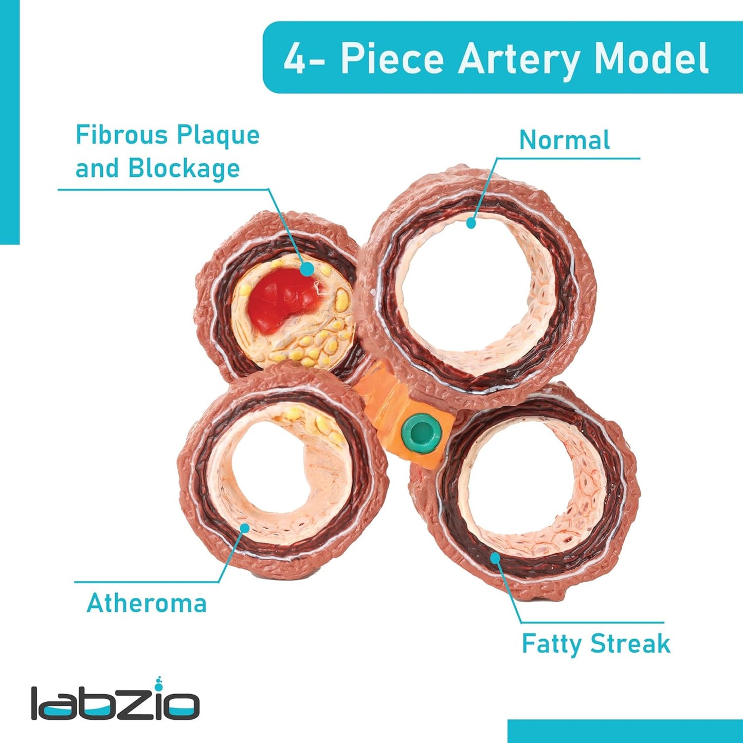Human Artery Model (Mini) Portraying 4 Stages of Cholesterol Atherosclerosis (Normal, Fatty Streak, Atheroma and Fibrous Plaque and Blockage)