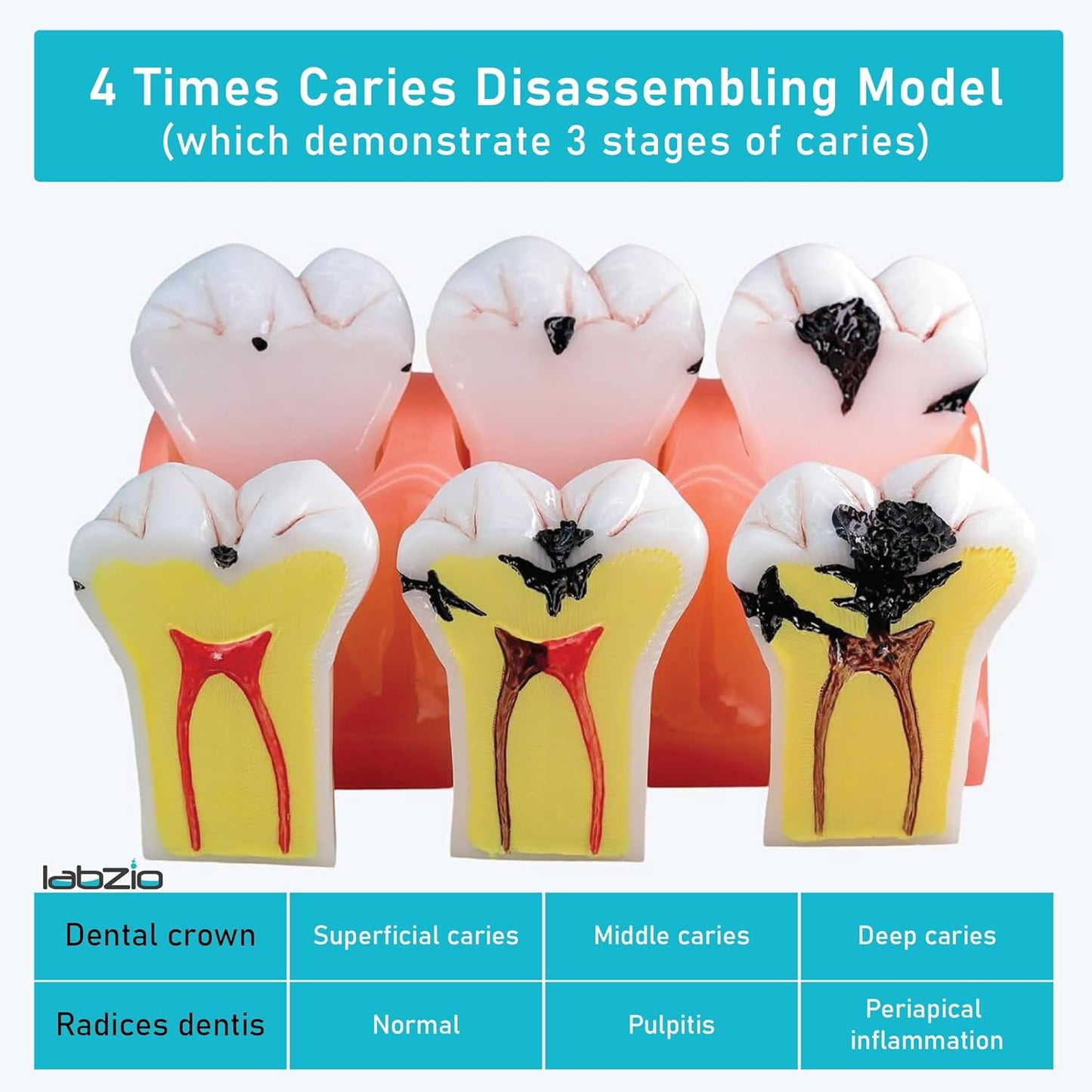 LABZIO Staged Model of Decaying Tooth, Removable and Dissectible Teeth, 7 Parts, Enlarged for Better Observation