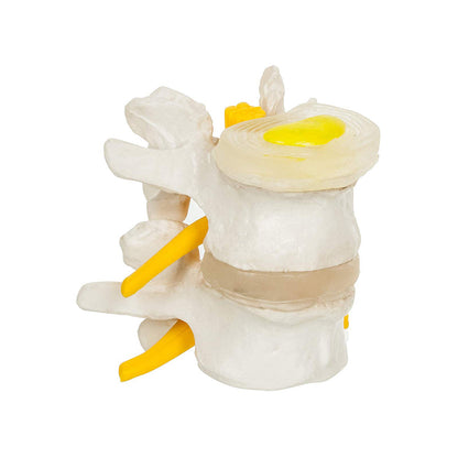 4 Stage Vertebrae Diseases Model, 4 Parts - Removable, Premium Anatomical Model, Model On Base with Detailed Study Guide