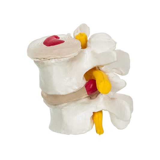 LABZIO, 4 Stage Vertebrae Diseases Model, 4 Parts, Removable, Premium Anatomical Model, Model On Base With Detailed Study Guide, White