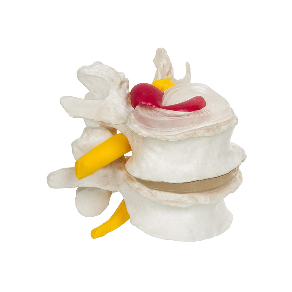 4 Stage Vertebrae Diseases Model, 4 Parts - Removable, Premium Anatomical Model, Model On Base with Detailed Study Guide