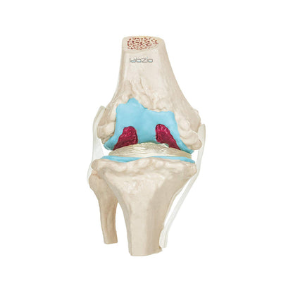 4 Stage Osteoarthritis Anatomical Knee Model, Model On Base, with Detailed Study Guide