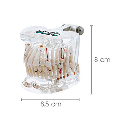 Premium Dental Model, Normal Dentition and Occlusion, Affected Side Shows Multiple Pathologies, Made of Yellowish Transparent High Quality Unbreakable Acrylic