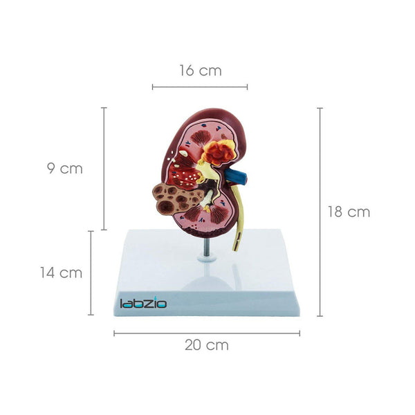 Deluxe Human Kidney Anatomical Model, Demonstrating Normal and Diseased Kidney with Pathologies, Medical Grade Anatomical Model