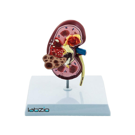 Deluxe Human Kidney Anatomical Model, Demonstrating Normal and Diseased Kidney with Pathologies, Medical Grade Anatomical Model