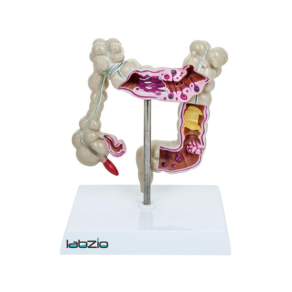Medical Anatomical Human Colon Diseased (Large Intestine) Model with Pathologies, Gastro Model, Perfect For Study and Patient Education