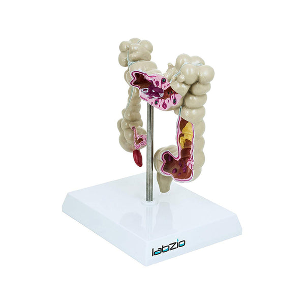 Medical Anatomical Human Colon Diseased (Large Intestine) Model with Pathologies, Gastro Model, Perfect For Study and Patient Education