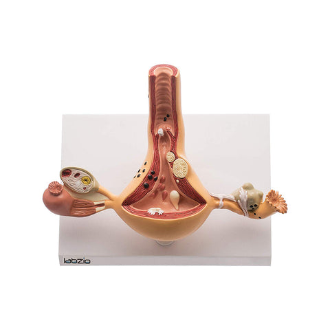Uterus and Ovary ,Female Reproductive Organ Anatomical Model with base showing the common Pathologies , coloured detailed key card included (1)