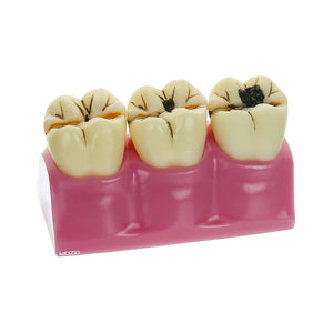Staged Model of Decaying Tooth, Removable and Dissectible Teeth, 7 Parts, Enlarged for Better Observation