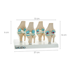 4 Stage Osteoarthritis Anatomical Knee Model, Model On Base, with Detailed Study Guide